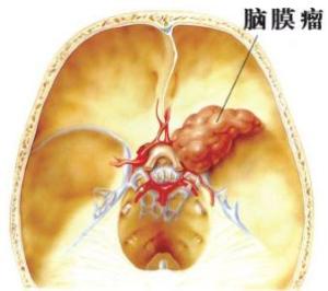 脑瘤