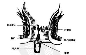 痔疮长条形图片