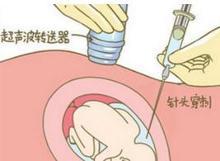 羊水穿刺检查