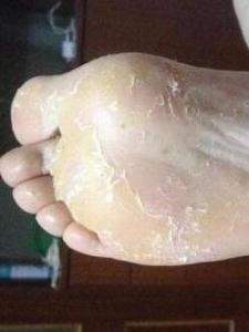 干脚气