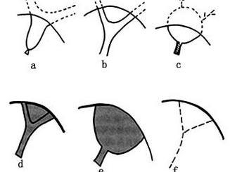 Ⅲ型：肝门区胆管闭锁，6个亚型(图3)。