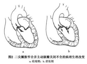 二尖瓣和主动脉瓣的疾患