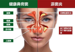 鼻窦炎 鼻窦炎