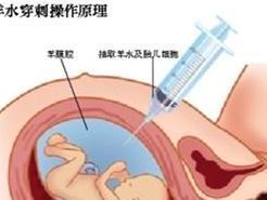 羊水穿刺