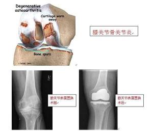 骨性关节炎