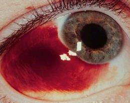 种病症,是眼科病的一种,导致该病发生的原因包括全身性血管病和血液病