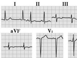 T波低平或倒置