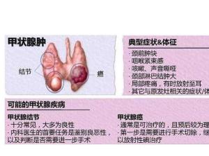 甲状腺癌