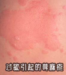荨麻疹