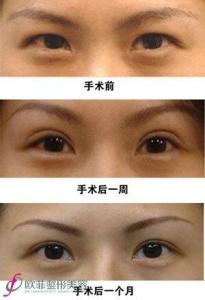 切开双眼皮手术案例对比图