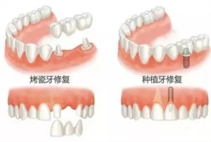 牙冠