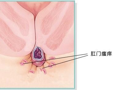 肛门瘙痒