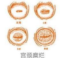 宫颈糜烂3度