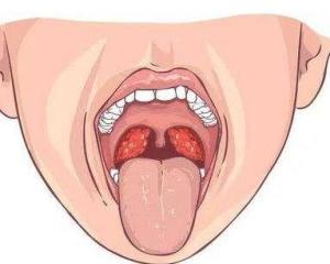 我的扁桃体已经做了双侧切除手术,为什么现在有炎症,还是嗓子疼?