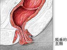 直肠脱垂
