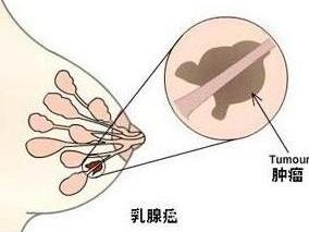 乳腺癌症状