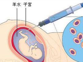 羊水穿刺