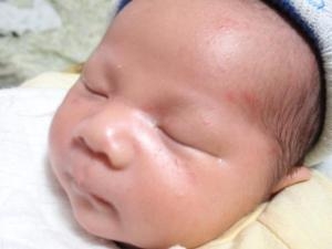 婴儿痤疮