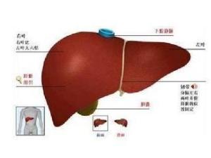 肝硬化 肝硬化