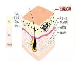 色素沉着用什么药缓解 300