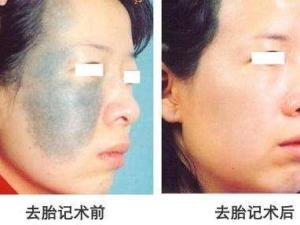 去胎记