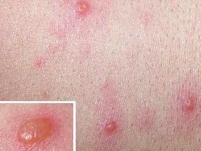 丘疹性荨麻疹,接触性皮炎,自身敏感性皮炎,汗疱疹,药疹,大疱性多形