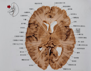 胼胝体立体解剖图图片