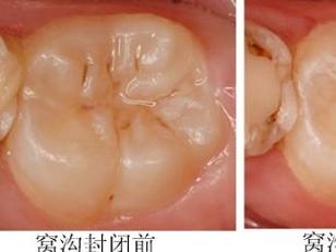 窝沟封闭 前后对比