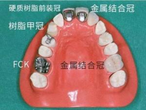 牙冠种类