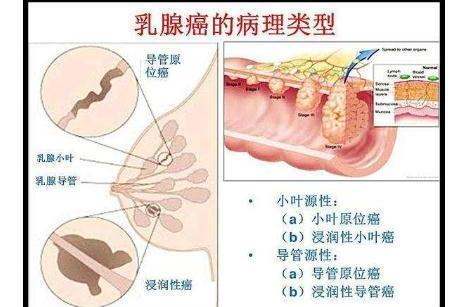 乳腺癌 乳腺腺上皮组织的恶性肿瘤 搜狗百科