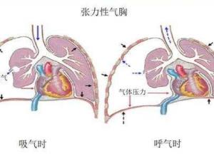 气胸