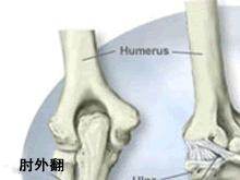 肘外翻