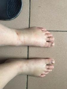 低蛋白血症