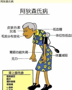 原发性肾上腺皮质功能减退症又称艾迪生病,是由肾上腺皮质功能低下