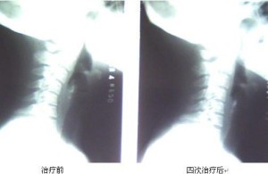 颈椎反弓治疗对比图