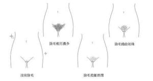阴毛
