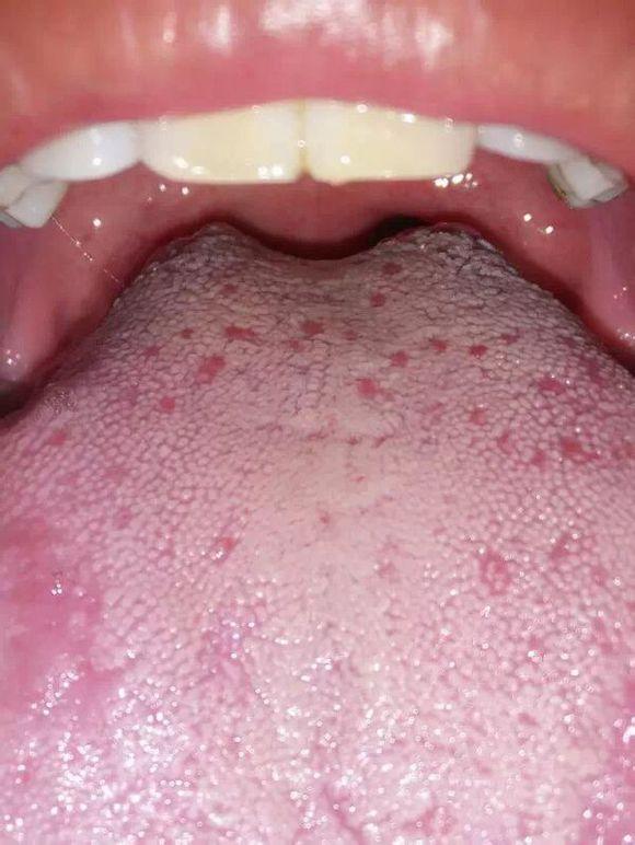 舌乳头炎照片图片