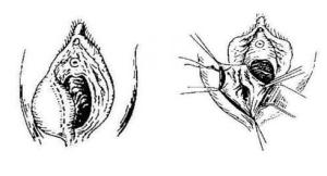 前庭大腺囊肿切除术