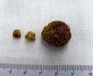 泥沙样胆囊结石