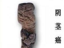 龟头癌关于龟头癌治疗,传统的治疗方式就是手术治疗