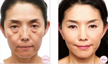 拉皮除皱