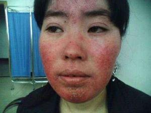 激素脸