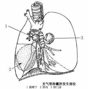 先天性肺囊肿