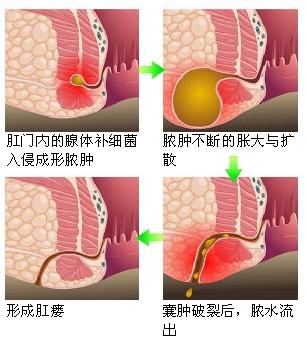 肛窦炎百科图片