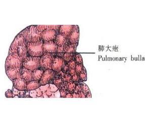 肺大泡 搜狗百科