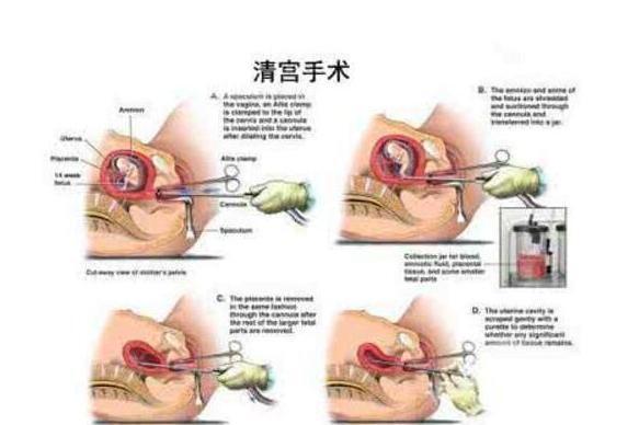 清宫手术(人工流产手术)