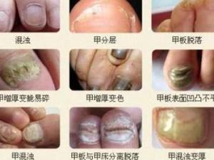 灰指甲