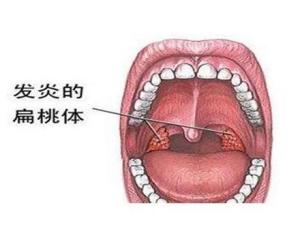 扁桃体发炎