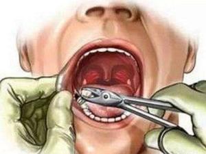 拔牙