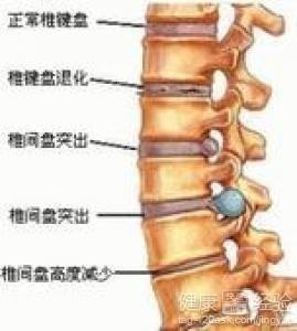 腰椎间盘突出怎么锻炼康复 300